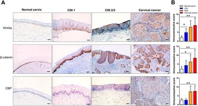 Wnt3a/β-Catenin/CBP Activation in the Progression of Cervical Intraepithelial Neoplasia